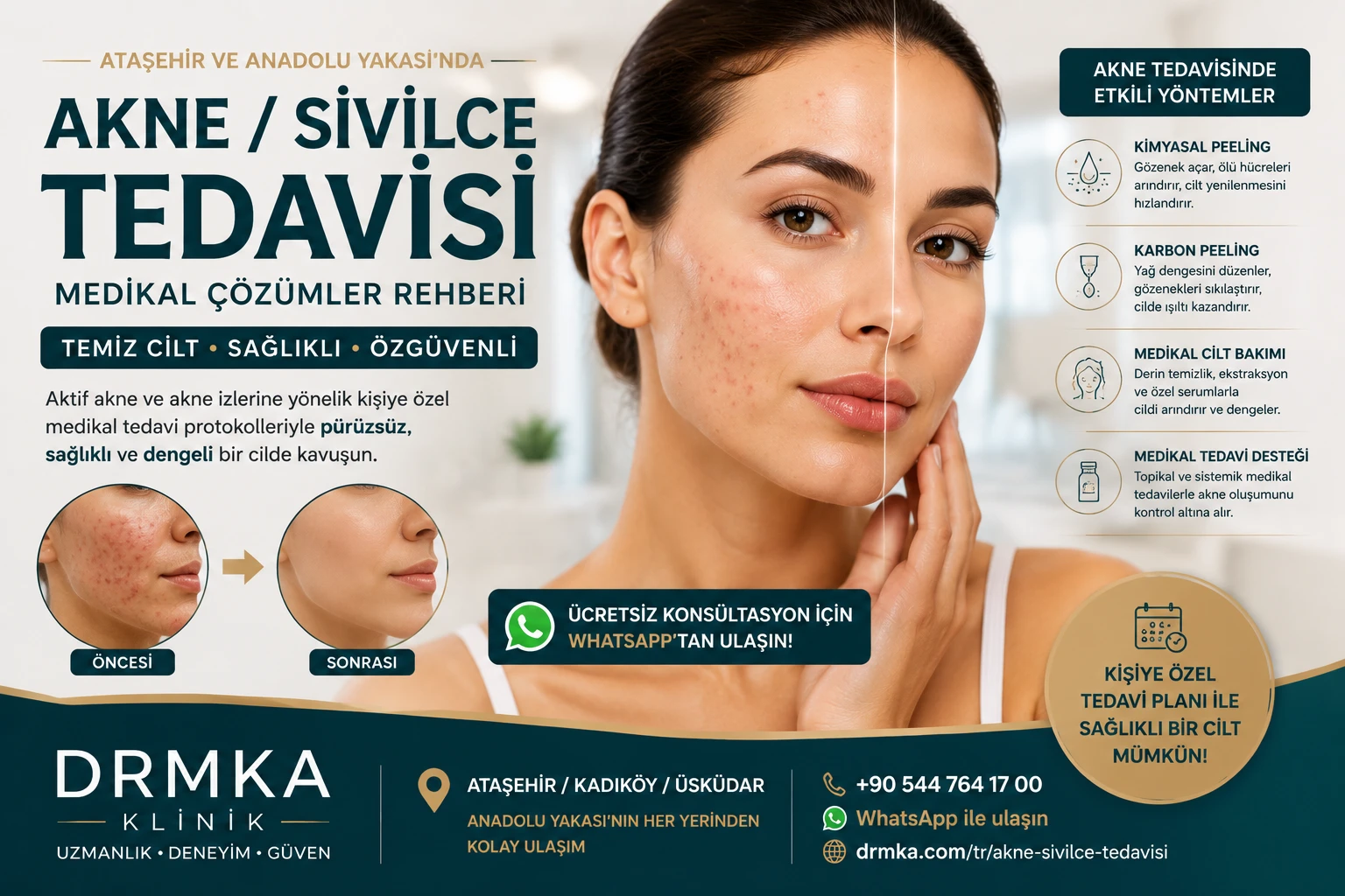 Ataşehir Akne ve Sivilce Tedavisi